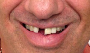 image of a missing tooth