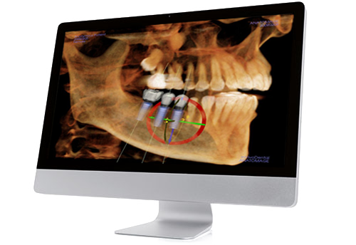 free CT scan and dental implant consultation