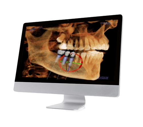 Dental Implanta X-ray image
