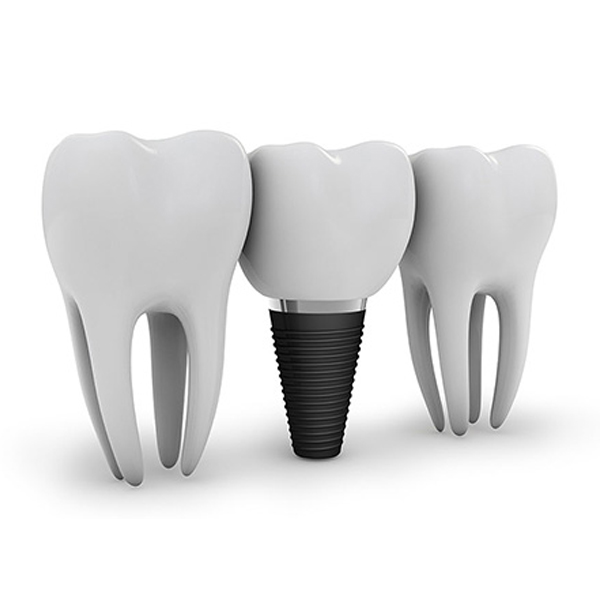 dental implants lehigh valley