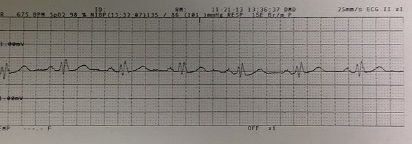 ekg results