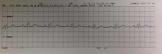 ekg