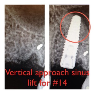 vertical-sinus-lift
