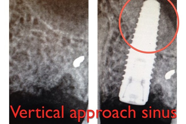 vertical sinus lift