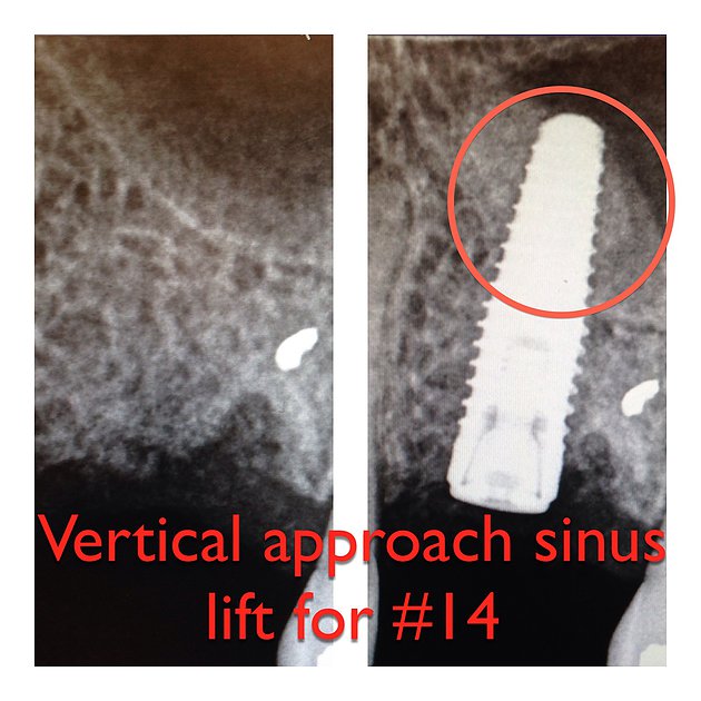 Vertical Sinus Lift Procedure Blog by Dr. Chaudhry