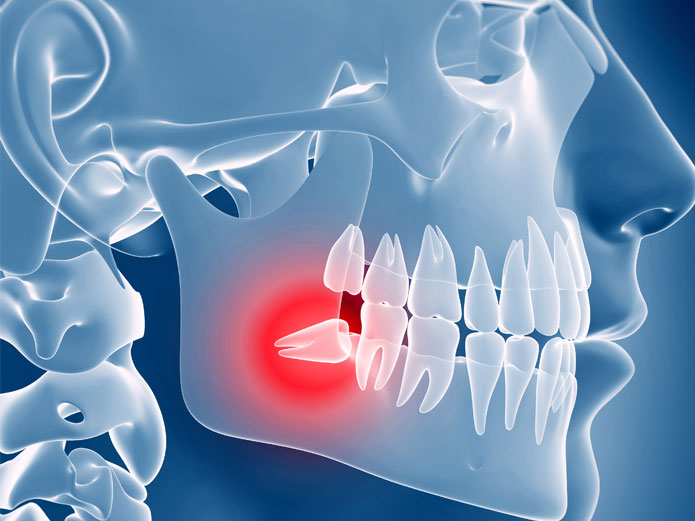 wisdom teeth romoval lehigh valley