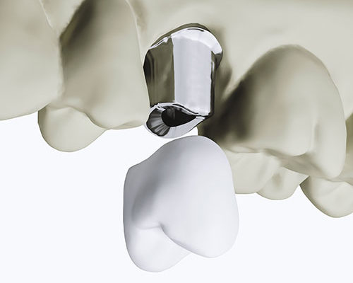 dental implants pieces