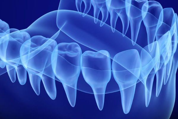 bone grafting model