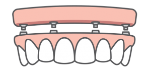All-on-4 implant icon.