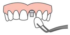 Single tooth implant replacement icon.