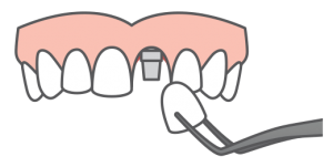 single tooth replacement icon